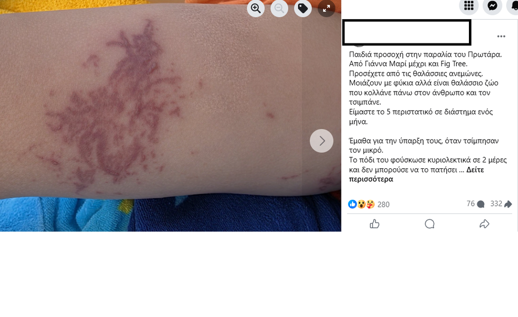 Οι θαλάσσιες ανεμώνες είναι δηλητηριώδεις οργανισμοί και πολίτες ανέφεραν θεάσεις τους σε κυπριακά νερά