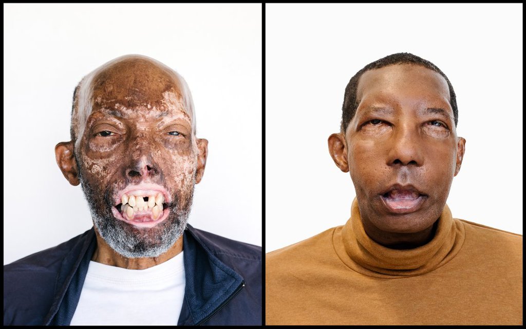 face-transplant-african-american-2-1.jpg
