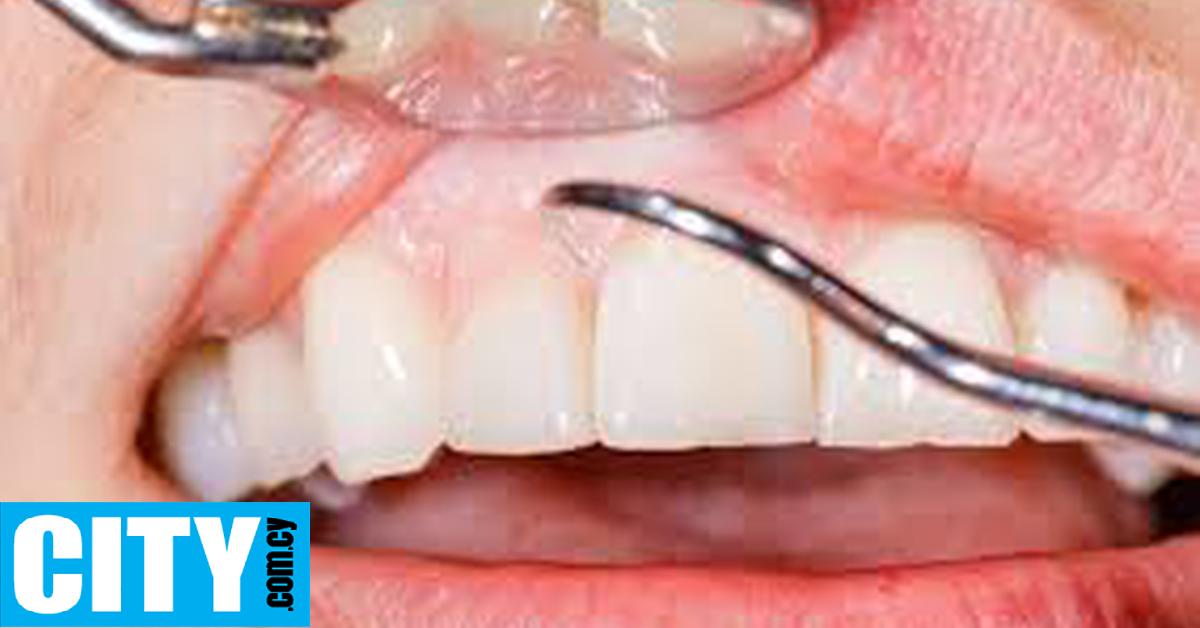 Πώς συνδέεται η ουλίτιδα με την εμφάνιση σοβαρών καρδιαγγειακών επεισοδίων