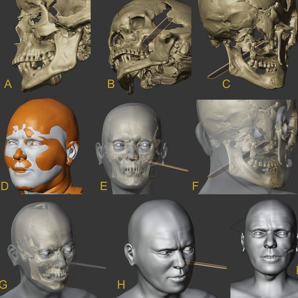 skynews-racesa-vampire-facial-reconstruction_7154010.jpg